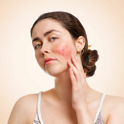 Type of rosacea and how the skin condition can be treated