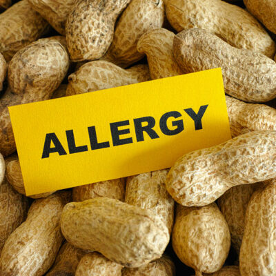 5 most common food allergies